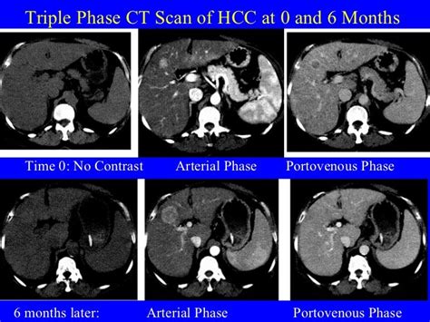 3 kwo hepatocellular cancer