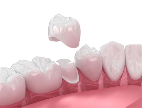 Porcelain crown in Turkey - cosmedicadental.com