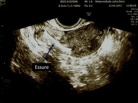 Essure Ultrasound