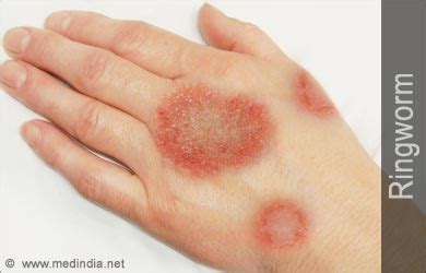 Ringworm | Tinea | Dermatophytosis: Causes Symptoms Signs Treatment FAQ