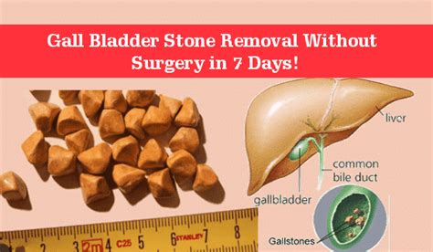 See Gall Bladder Stone Removal Without Surgery in 7 Days! - Right Home ...