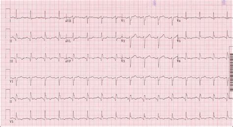 How to assess acute coronary syndrome | 12- lead EKG case