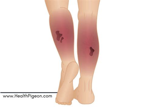 Necrotizing Fasciitis: Causes, Risk factors, Symptoms and Treatment. | HealthPigeon