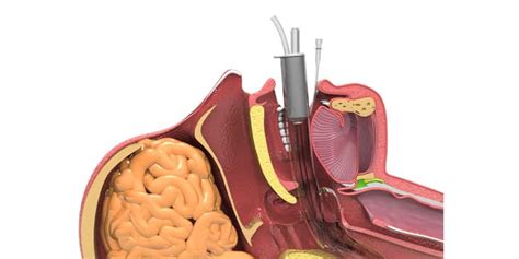 Laryngeal Mask Airway Insertion