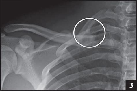 Traumatic First-Rib Fracture in a Collegiate Football Player: A Case Review | Athletic Training ...