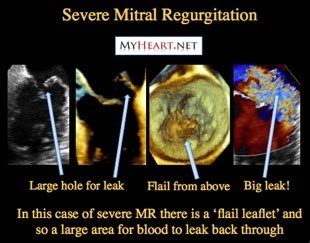 Leaky Heart Valve – When The Mitral Valve Fails