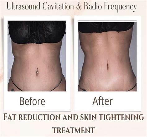 Body Contouring Valencia | Body Sculpting Near Me