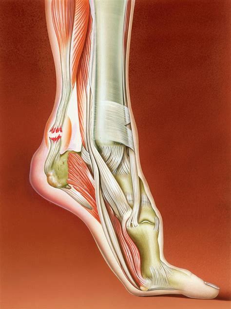 Achilles Tendon Rupture Photograph by John Bavosi - Pixels