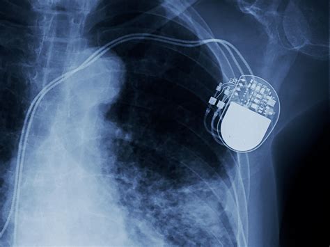 Pacemakers and Implantable Defibrillators | MedlinePlus