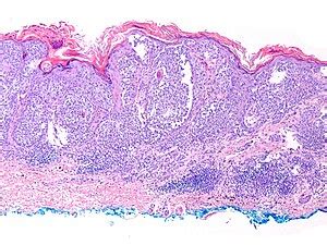 Malignant Melanoma Histology