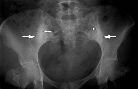 Sacroiliitis | Radiology Key