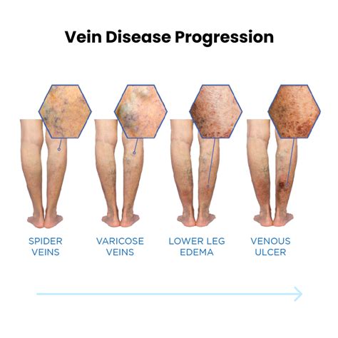 Vein Care 101: Vein Disease Explained | Metro Vein Centers