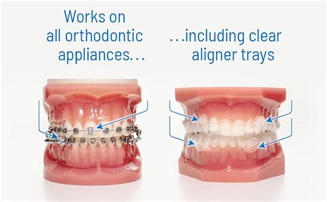 OrthoDots CLEAR - 72 Count Moisture Activated Dental Wax Alternative for Braces & Aligners