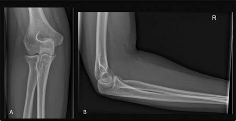 Trauma Elbow X Ray Positioning