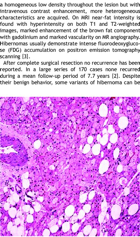 Histology revealed round and polygonal cells, multivaoculated with... | Download Scientific Diagram