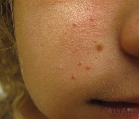 Unilateral Papules on the Face | MDedge Dermatology