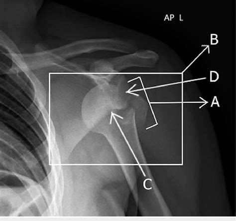 Anterior-posterior X-ray showing the anterior left glenohumeral joint... | Download Scientific ...