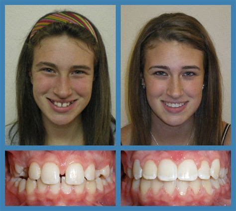 Another Beautiful Example of Before and After #Braces From Our Office | Dentistry, Teeth braces ...