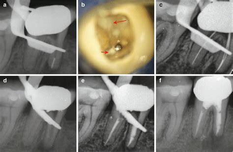 Separated Endodontic Instruments | Pocket Dentistry