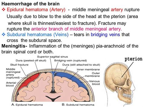 Epidural Hematoma Definition Treatment And Outlook - IMAGESEE