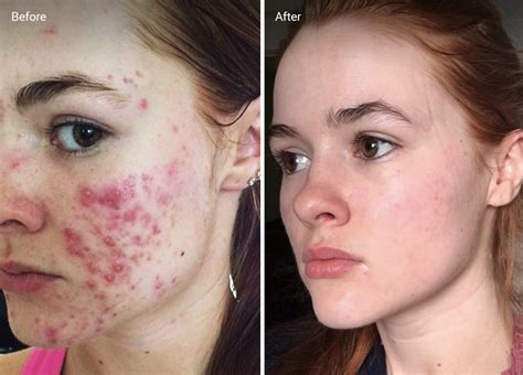 Accutane for Acne: How to Use It, Safety, Side Effects and More