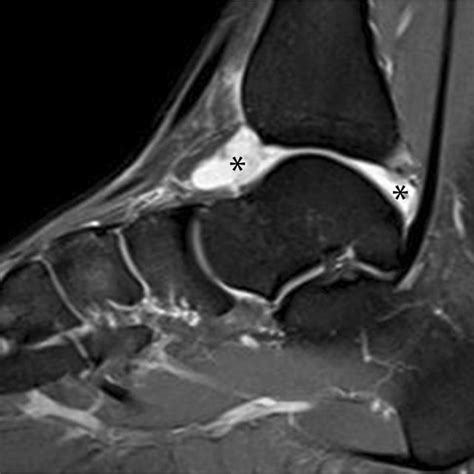 Sagittal Proton Density Weighted Mri Shows Grade Effusion In The | My XXX Hot Girl