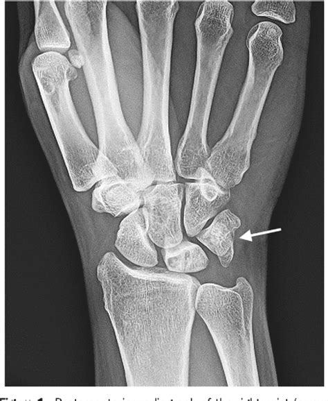 Figure 1 from Woman With Wrist Pain After Falling. Isolated pisiform dislocation. | Semantic Scholar