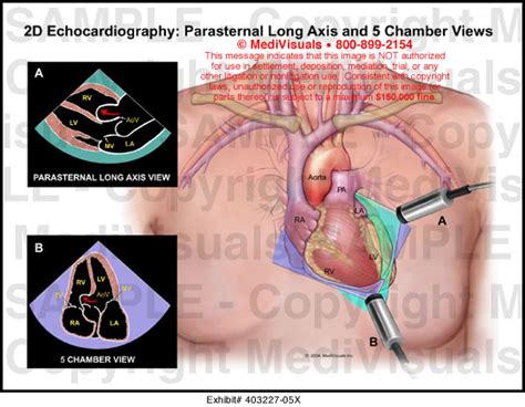 2D Echocardiography: Parasternal Long Axis and 5 Chamber Views