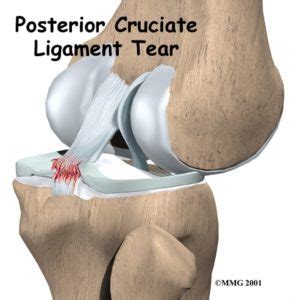 PCL Injury and Reconstruction – Howard J. Luks, MD