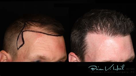 Hair Restoration Before and After | Premier Plastic Surgery