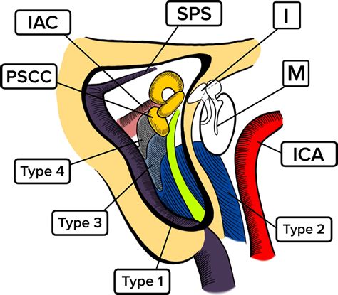 Jugular bulb and skull base pathologies: proposal for a novel classification system for jugular ...