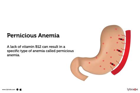 Pernicious Anemia: Treatment, Procedure, Cost, Recovery, Side Effects And More