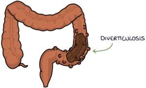 Diverticular Disease – Zero To Finals