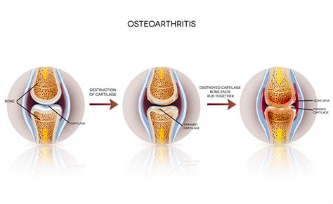 Osteoarthritis - Inspire Health Magazine