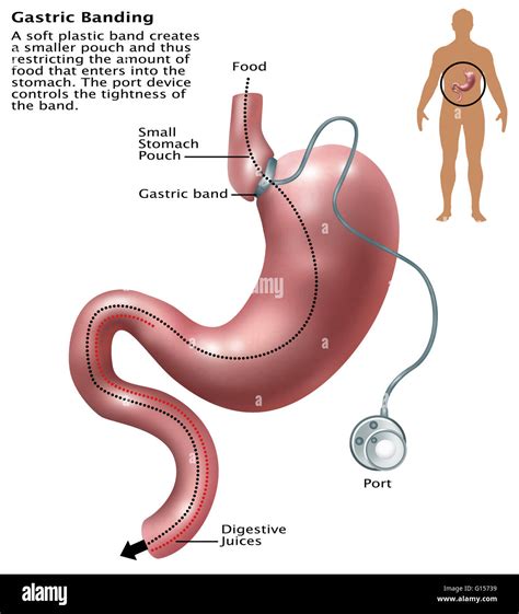 Illustration of gastric banding. A laparoscopic adjustable gastric band, commonly called a lap ...