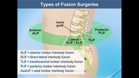 Same Day Lumbar Spine Fusion Surgery - YouTube