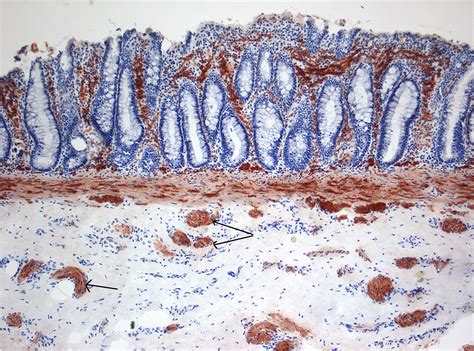 Hirschsprung's disease pathophysiology - wikidoc