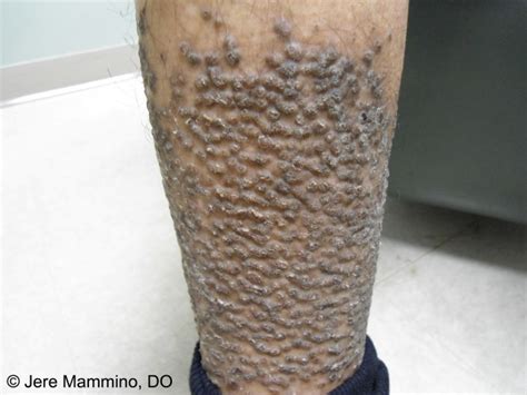 Lichen Amyloidosis - American Osteopathic College of Dermatology (AOCD)