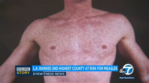 Measles outbreak: L.A. County is 2nd most vulnerable place in country ...