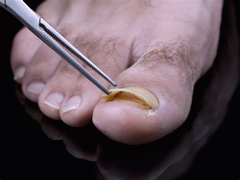 Toenail fungus treatment - Atlanta Podiatrists: Atlanta Foot and Ankle Specialists