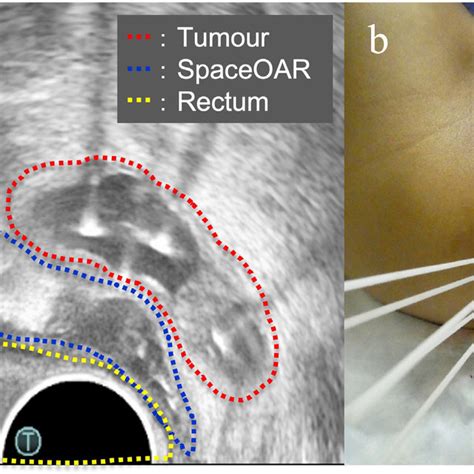 (a) Axial view of the transrectal ultrasound after implantation of the... | Download Scientific ...