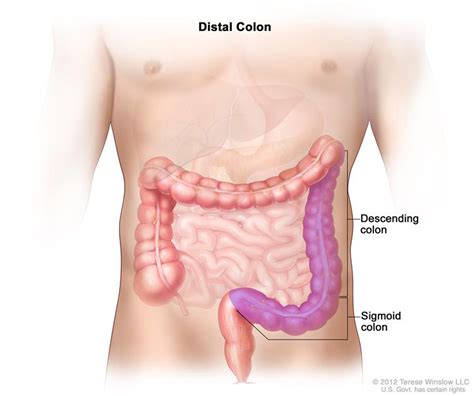 Diagram of Distal Colon – Holistic Hernia Remediation