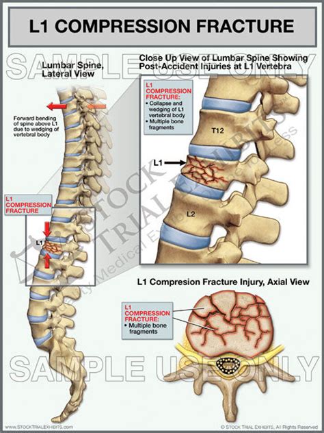 Lumbar Spine L1 Compression Fracture Trial Exhibit – Stock Trial Exhibits