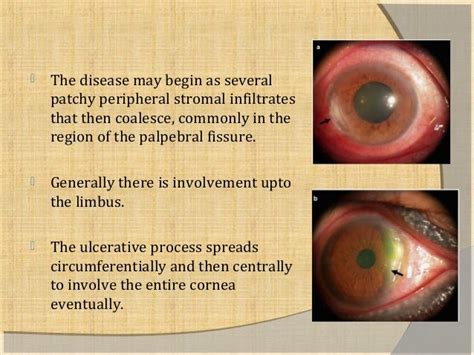 Mooren’s ulcer