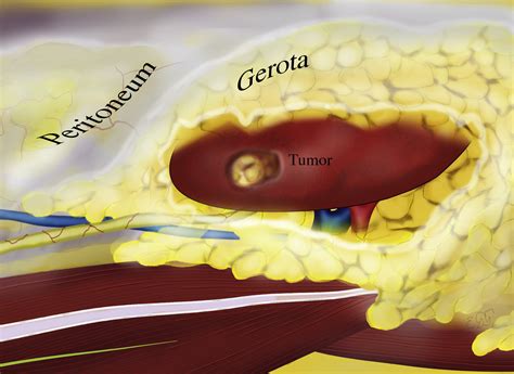 Technique and Outcomes of Robot-assisted Retroperitoneoscopic Partial Nephrectomy: A Multicenter ...