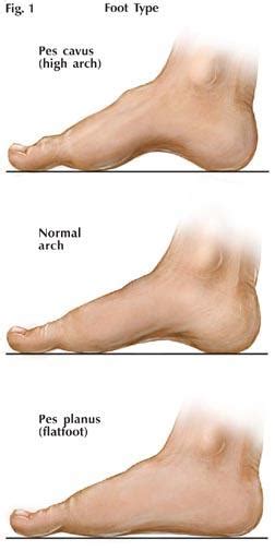 Pes Cavus vs Pes Planus vs Normal Arch – Dr. Soroush Khoshroo – Chiropractor