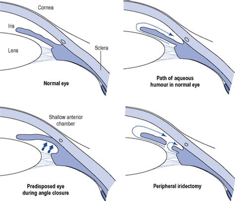 Glaucoma | Basicmedical Key