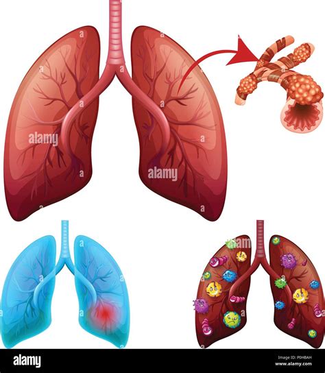 Lung cancer drawing hi-res stock photography and images - Alamy