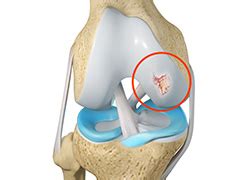 Chondroplasty Chandler, AZ | Shoulder Impingement Mesa, Queen Creek