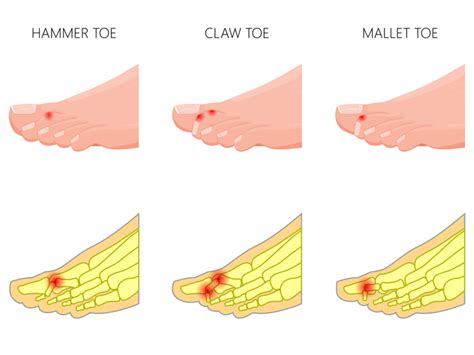 Hammer Toe, Claw and Mallet Toe - Highgate Podiatry Orthotic Insoles